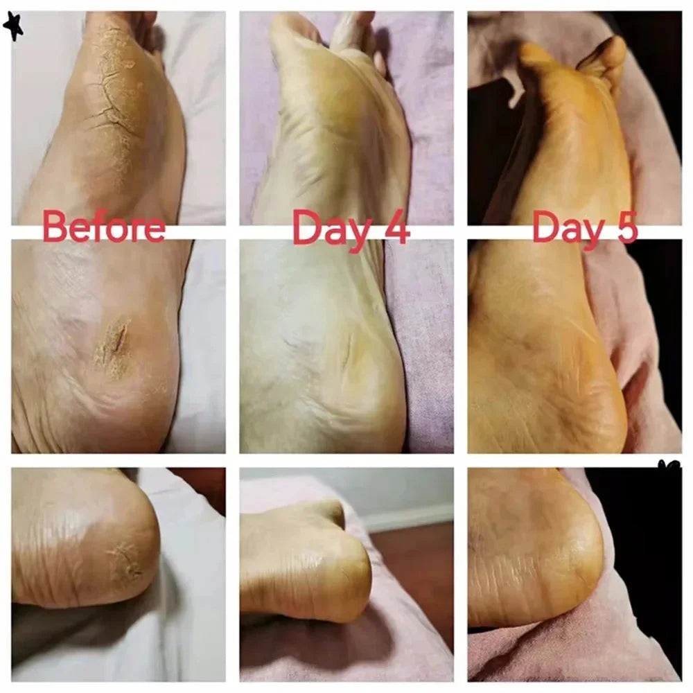 Herbal Anti Crack Foot Cream